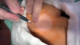 大阪粉瘤クリニック 当日施術可 女医対応可 クリニーク大阪心斎橋 大阪梅田院 神戸三宮院 名古屋栄院 福岡院 院長ブログ 美容外科 美容皮膚科 クリニーク大阪心斎橋