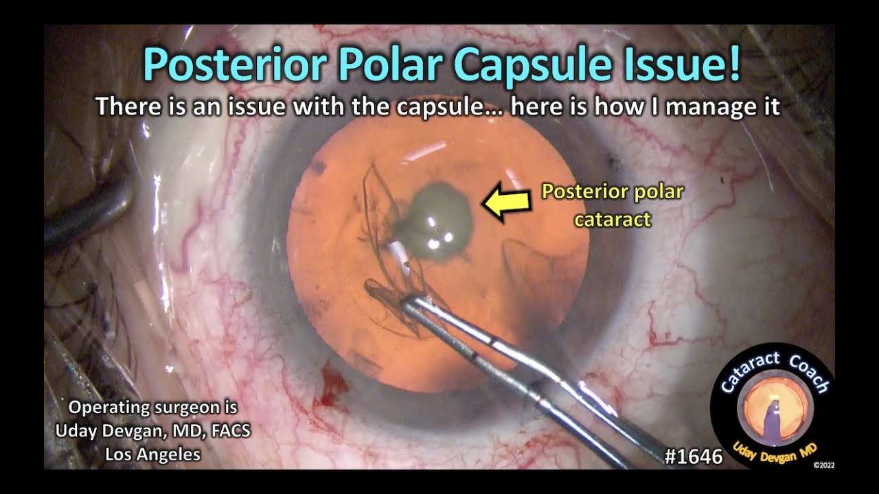 CataractCoach 1646: posterior polar cataract with a capsule issue - YouTube