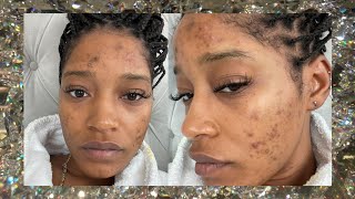 Keke Palmer Has PCOS 😥🙏🏽