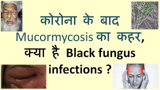 क्या है Black Fungus Infections ? । कोरोना के बाद Mucormycosis का कहर