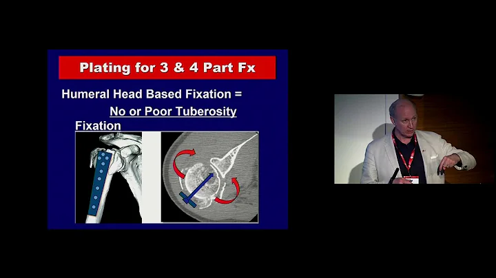 Proximal humeral fractures - how my practise has evolved by Dr Michael McKee