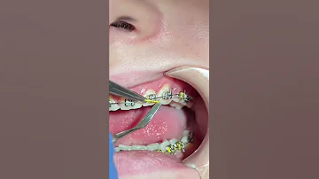 Эластические лигатуры для металлических брекетов
