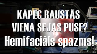 Kāpēc raustās viena sejas puse? Hemifaciāls spazms.