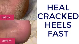 How to Quickly Heal Cracked Dry Feet \& Heels Naturally | DIY Natural Treatment for Cracked Heels
