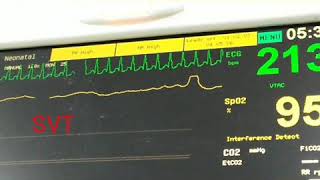 Adenosine effect