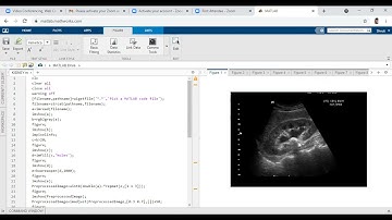 kidney stone detection using digital image processing