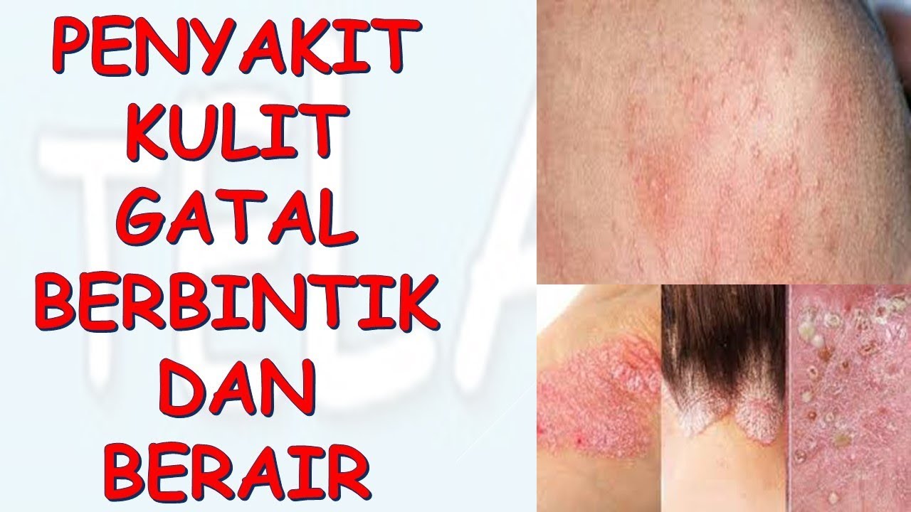 penyakit kulit gatal berbintik dan berair obat alami 