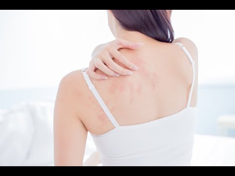 Vídeo: Dermatite De Radiação: Causas, Sintomas E 5 Métodos De Tratamento