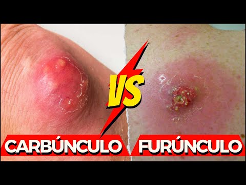 Vídeo: O que causa furúnculos e carbúnculos?