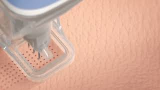 ellacor® System with Micro-Coring™ technology