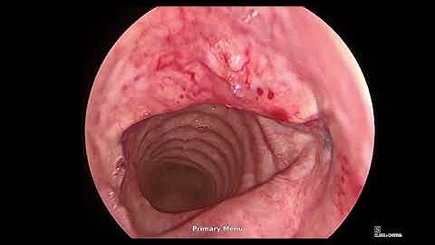 Tracheal Pulsations from AOD