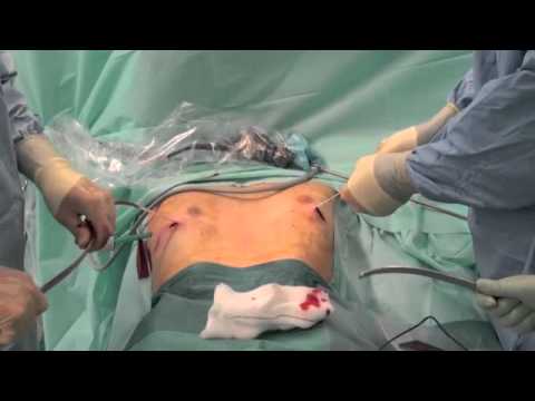 Nuss Procedure for Pectus Excavatum  - Edinburgh