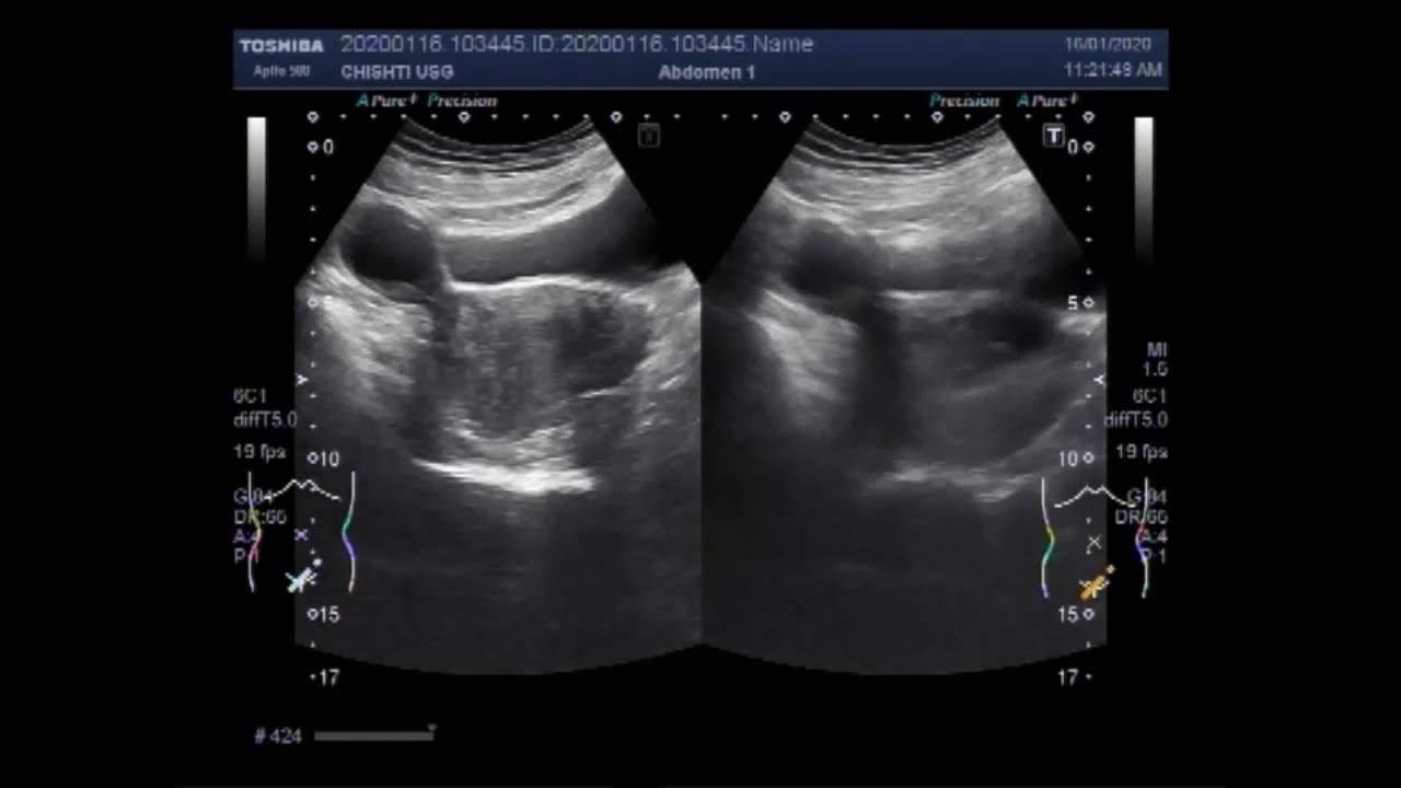Ultrasound Video showing a Large hemorrhagic ovarian cyst with a small ...