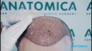 Lotion Application in the Washing Process after Hair Transplantation