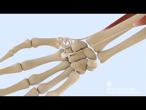 Video: Behandlung Von Arthrose Mit Kräuterpräparaten