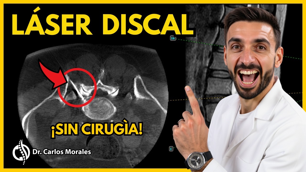 🎯 Descompresión láser (PLDD): Nuevo tratamiento para la hernia discal - 🙅‍♂️ SIN CIRUGÍA