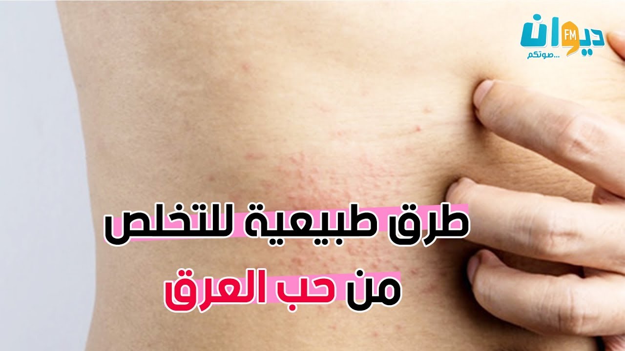 حب العرق من أكثر الحاجات الي يقلقونا في السخانة...تبعونا نعطيوكم طرق طبيعية باش تتخلصو منهم