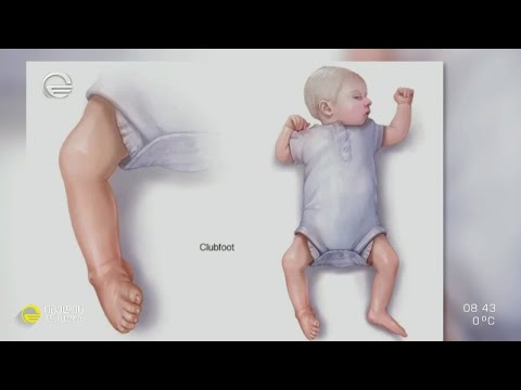 ბრტყელტერფიანობა ბავშვებში - პრევენცია, დადგენის ასაკი და საჭიროებები