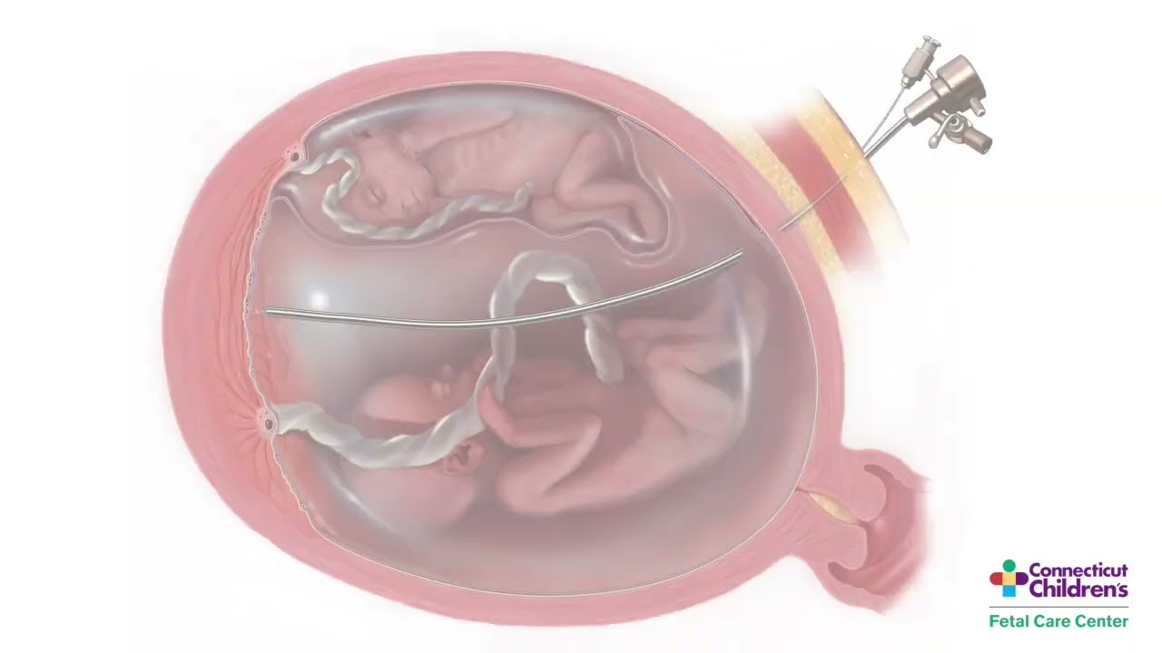 Twin-Twin Transfusion Syndrome: Fetoscopic Laser Photocoagulation
