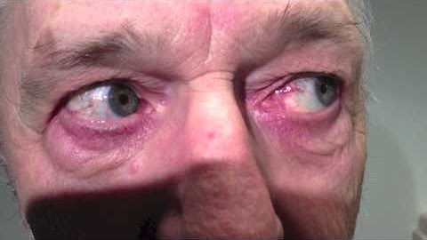 Positive Head Impulse Test 4