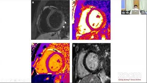 VIÊM CƠ TIM CẤP Ở TRẺ EM | BS. Nguyễn Trung Kiên