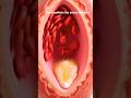How Heart Attack Occurs #animation #insight #human #shortsfeed #heart #shorts