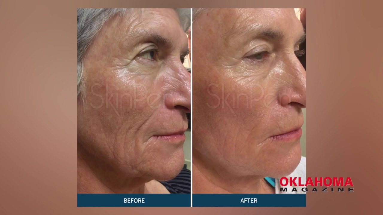 SkinPen and PRP skin treatment at Tulsa Surgical Arts YouTube
