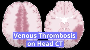 Venous Thrombosis on Head CT