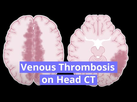 Video: Cerebral Venøs Trombose (CVT): Symptomer Og Behandling