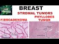 Diseases of Breast: Part 3: Fibroadenoma & Phyllodes tumor