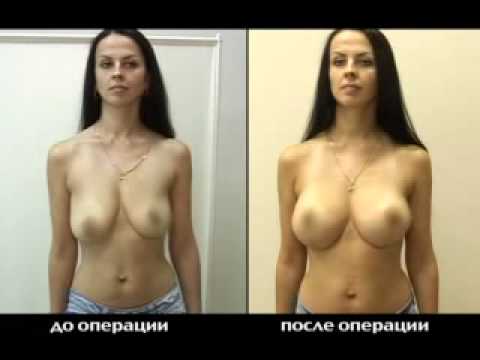 Упражнения для увеличения груди подростка