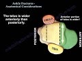 Ankle Fractures , Anatomical Considerations - Everything You Need To Know - Dr. Nabil Ebraheim