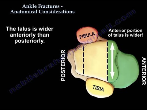 Ankle Fractures ,