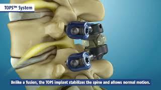 TOPS System | Cures Lumbar Spinal Stenosis, Spondylolisthesis
