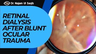 Retinal Dialysis After Blunt Ocular Trauma