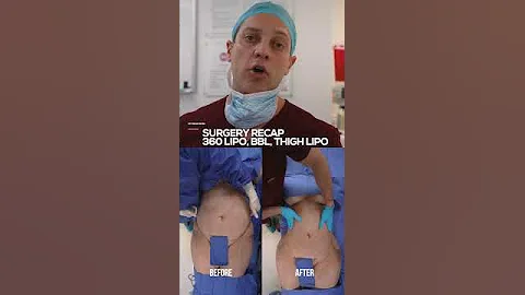 360 Lipo & BBL Results You Won’t Believe | Stunning Before & After!