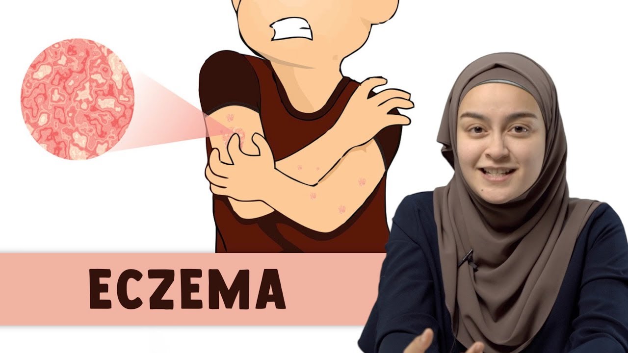 Eczema