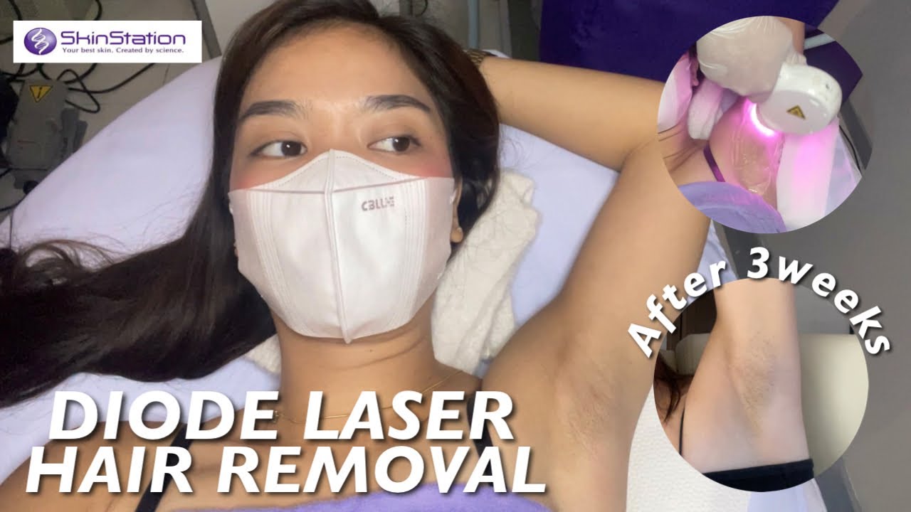 DIODE LASER HAIR REMOVAL | SKINSTATION (1st Session)