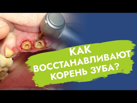 Корень зуба. Наращивание.