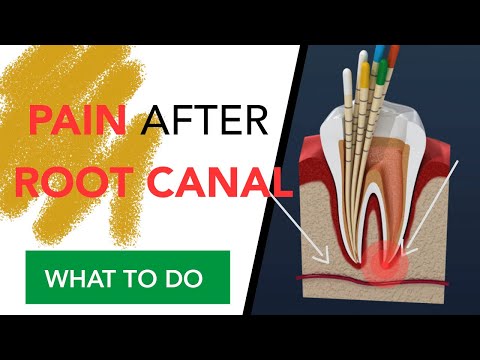 Pain After Root Canal | WHAT TO DO