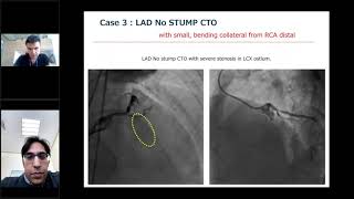 Retrograde CTO Technique: What is essential?