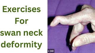 Exercise For Swan Neck Deformityhow To Fix Swan Neck Deformityphysiotherapytreatments