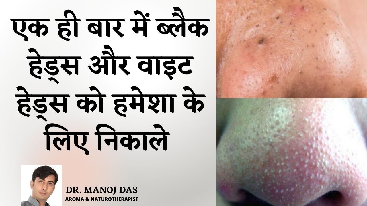 Remove Blackheads from Nose in 1 USE | Remove Whiteheads from Chin, Nose, Face I DR. MANOJ DAS