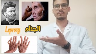 مرض الجذام أسبابه وأعراضه وعلاجه - Leprosy: its causes, symptoms and treatment