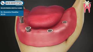113  Implant  Four Implants with Denture & Precision Bar