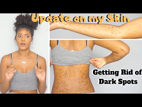 UPDATE on WHAT HAPPENED TO MY SKIN| Getting Rid of DARK SPOTS and HYPERPIGMENTATION