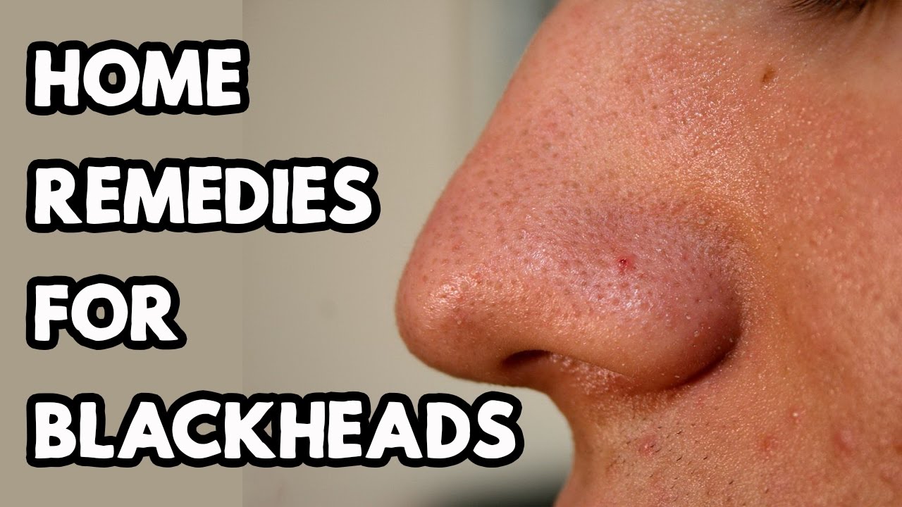 How to Get Rid of Blackheads | Home Remedies for Blackheads | Remove