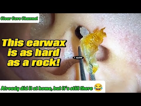 Ear Rocks Treatment This earwax is as hard as a rock! | Ear Wax Removal Pro - YouTube