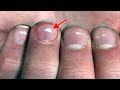What Causes White Spots On Nails.! My Grandmother Told this Secret What white marks on nails mean