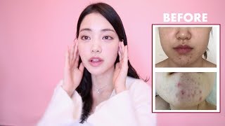 How I Got Rid of Hormonal Acne Naturally